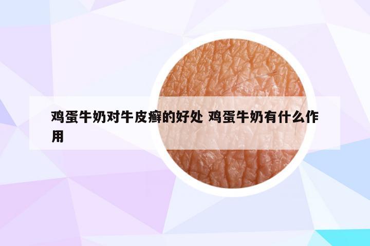 鸡蛋牛奶对牛皮癣的好处 鸡蛋牛奶有什么作用