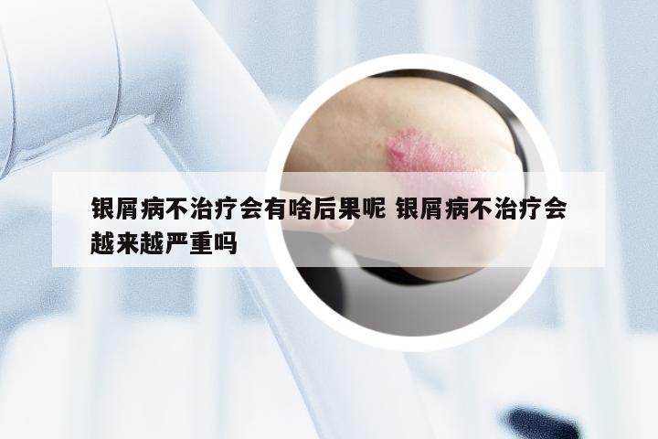 银屑病不治疗会有啥后果呢 银屑病不治疗会越来越严重吗