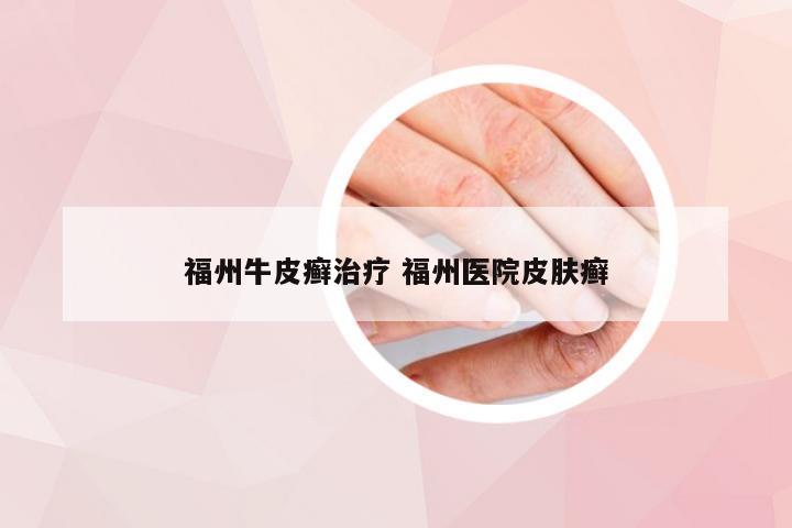 福州牛皮癣治疗 福州医院皮肤癣