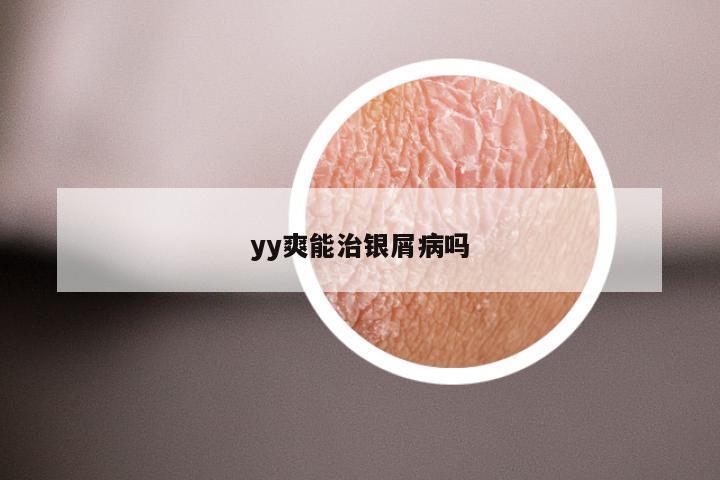 yy爽能治银屑病吗