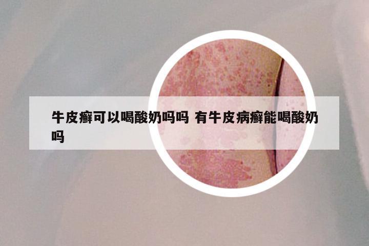 牛皮癣可以喝酸奶吗吗 有牛皮病癣能喝酸奶吗