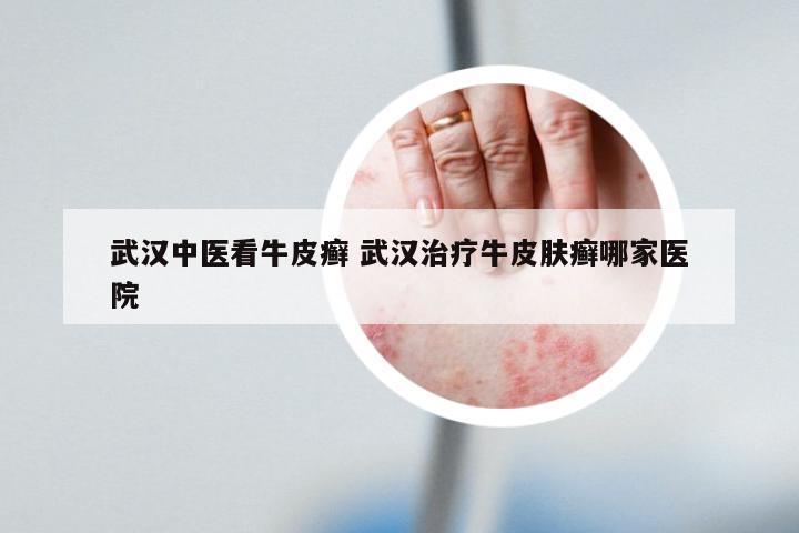 武汉中医看牛皮癣 武汉治疗牛皮肤癣哪家医院