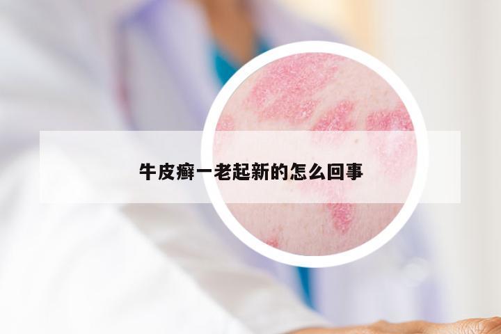 牛皮癣一老起新的怎么回事