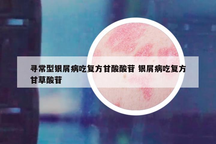 寻常型银屑病吃复方甘酸酸苷 银屑病吃复方甘草酸苷