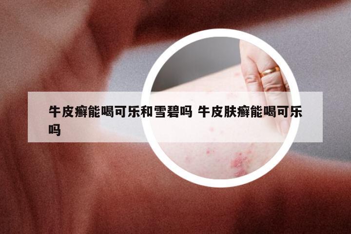 牛皮癣能喝可乐和雪碧吗 牛皮肤癣能喝可乐吗