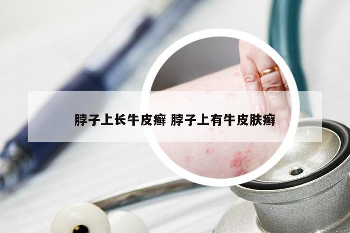 脖子上长牛皮癣 脖子上有牛皮肤癣