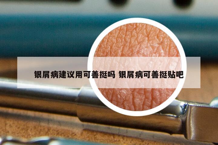 银屑病建议用可善挺吗 银屑病可善挺贴吧
