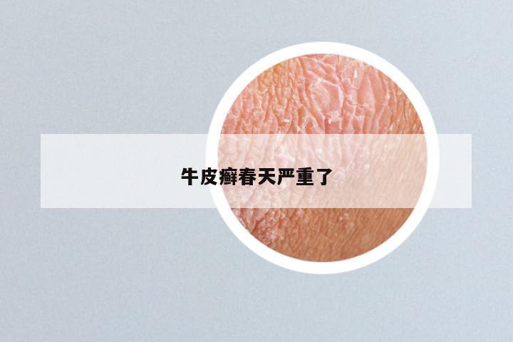 牛皮癣春天严重了
