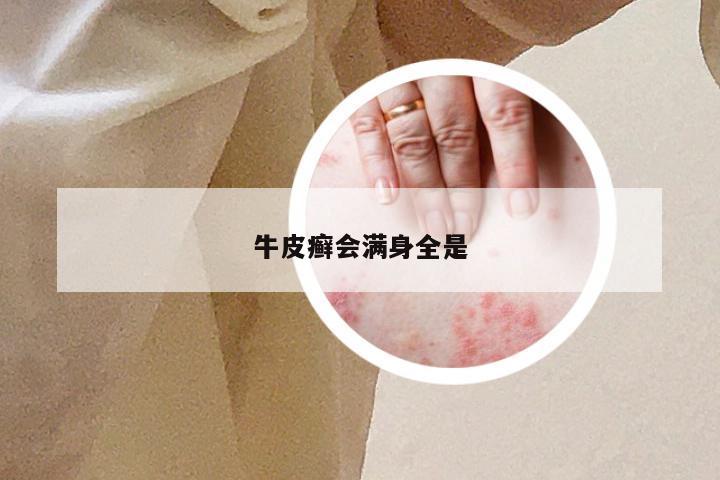牛皮癣会满身全是