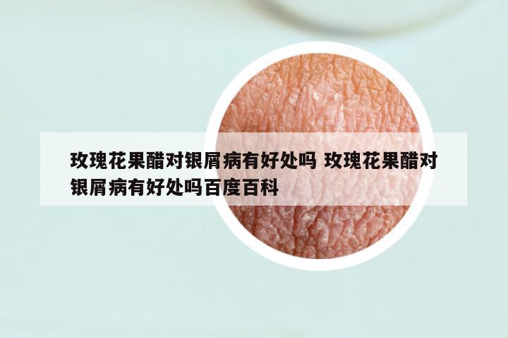 玫瑰花果醋对银屑病有好处吗 玫瑰花果醋对银屑病有好处吗百度百科