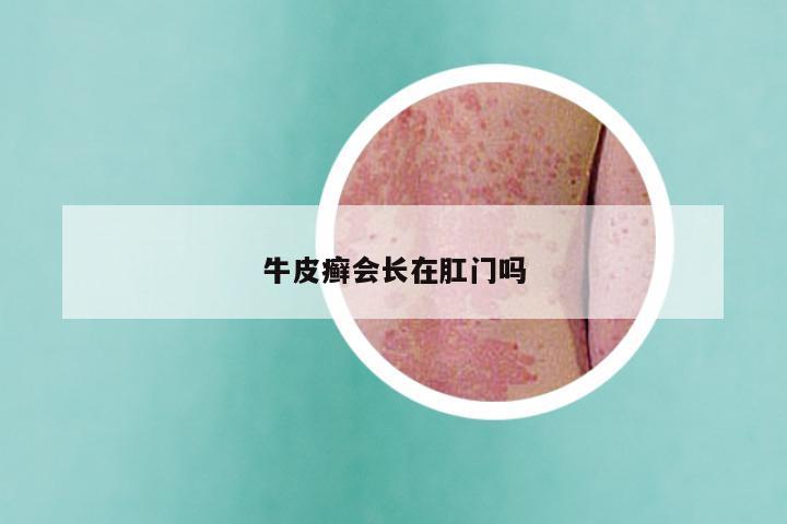 牛皮癣会长在肛门吗