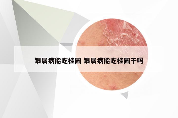 银屑病能吃桂圆 银屑病能吃桂圆干吗