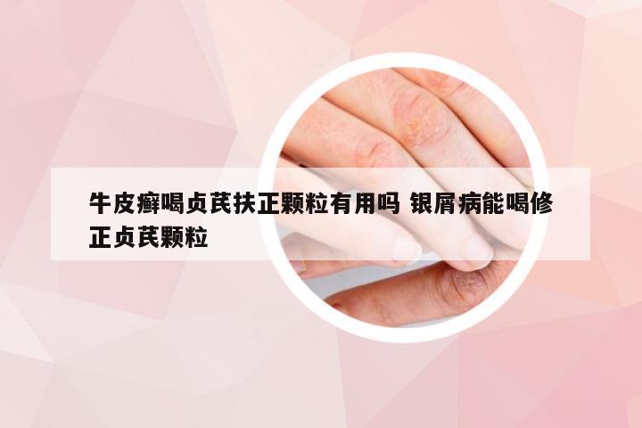 牛皮癣喝贞芪扶正颗粒有用吗 银屑病能喝修正贞芪颗粒