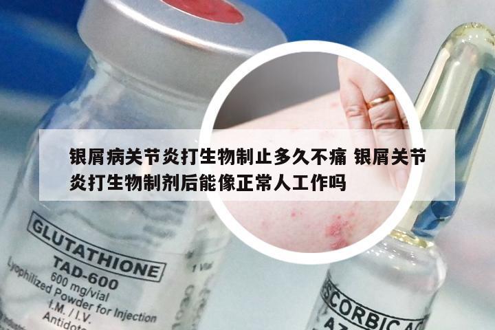 银屑病关节炎打生物制止多久不痛 银屑关节炎打生物制剂后能像正常人工作吗