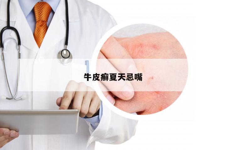 牛皮癣夏天忌嘴