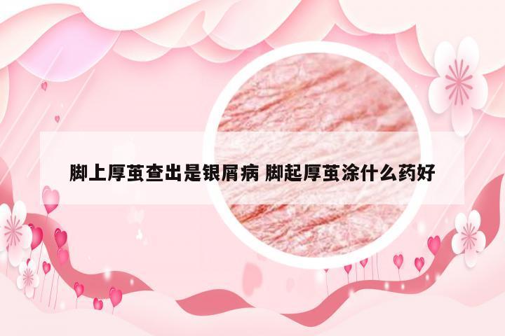 脚上厚茧查出是银屑病 脚起厚茧涂什么药好