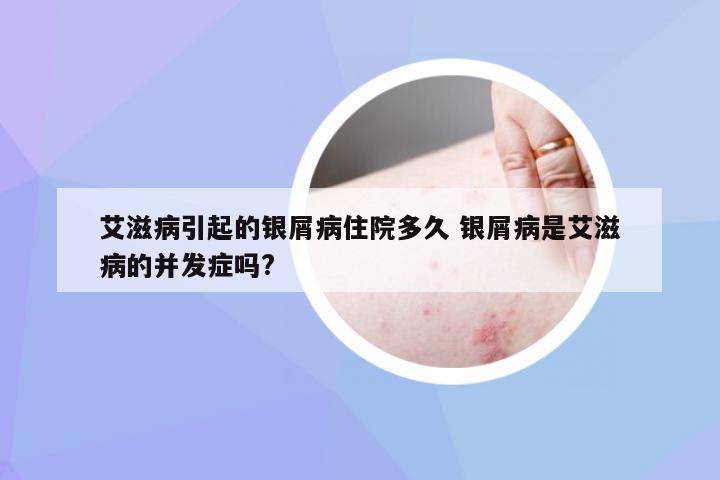 艾滋病引起的银屑病住院多久 银屑病是艾滋病的并发症吗?