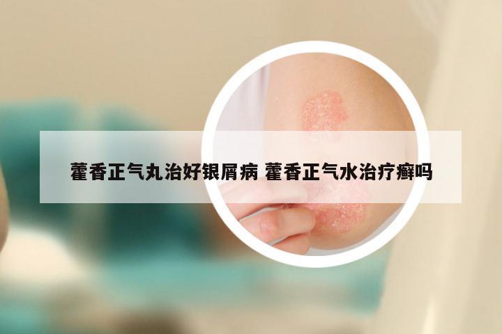 藿香正气丸治好银屑病 藿香正气水治疗癣吗