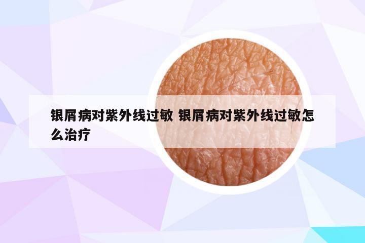 银屑病对紫外线过敏 银屑病对紫外线过敏怎么治疗