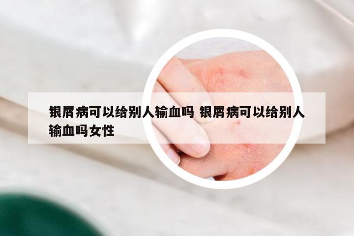 银屑病可以给别人输血吗 银屑病可以给别人输血吗女性