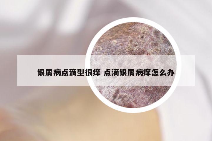银屑病点滴型很痒 点滴银屑病痒怎么办