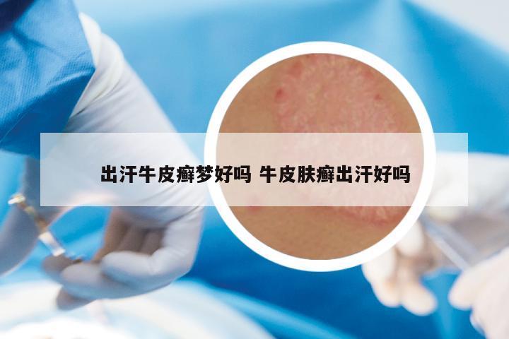 出汗牛皮癣梦好吗 牛皮肤癣出汗好吗