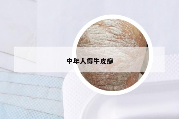 中年人得牛皮癣