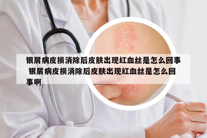 银屑病皮损消除后皮肤出现红血丝是怎么回事 银屑病皮损消除后皮肤出现红血丝是怎么回事啊