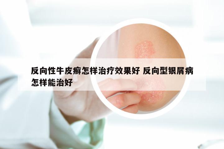 反向性牛皮癣怎样治疗效果好 反向型银屑病怎样能治好