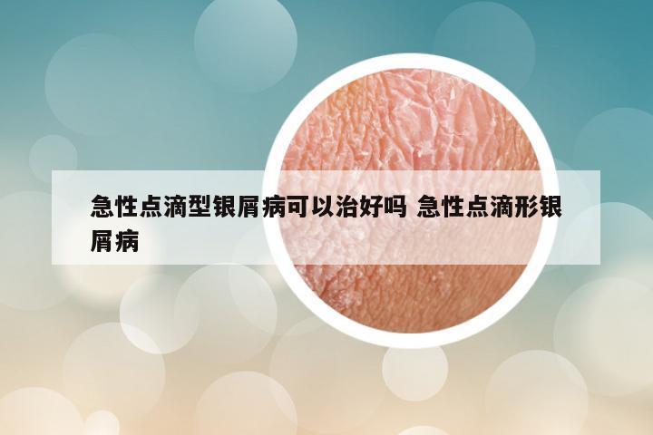 急性点滴型银屑病可以治好吗 急性点滴形银屑病