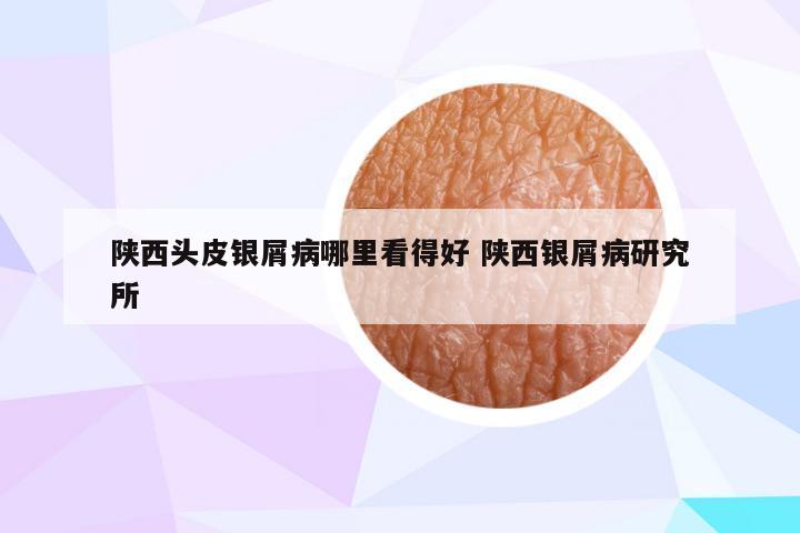 陕西头皮银屑病哪里看得好 陕西银屑病研究所