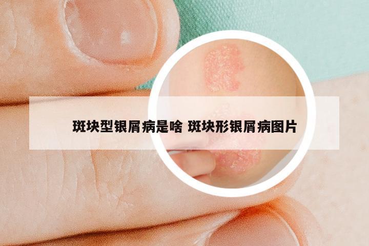 斑块型银屑病是啥 斑块形银屑病图片