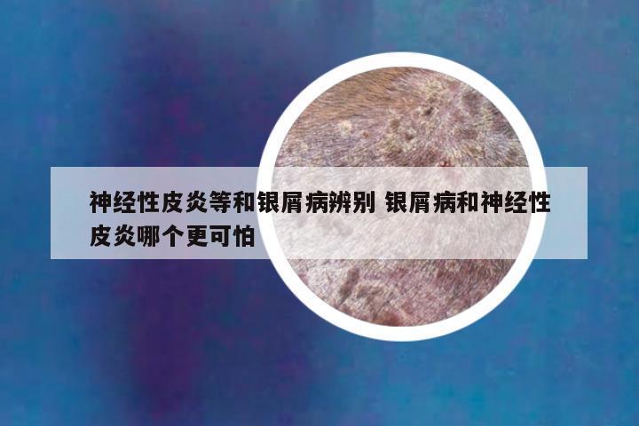 神经性皮炎等和银屑病辨别 银屑病和神经性皮炎哪个更可怕