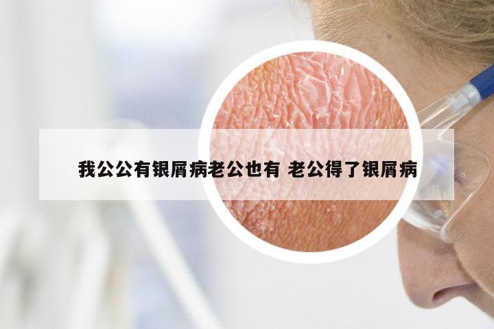我公公有银屑病老公也有 老公得了银屑病