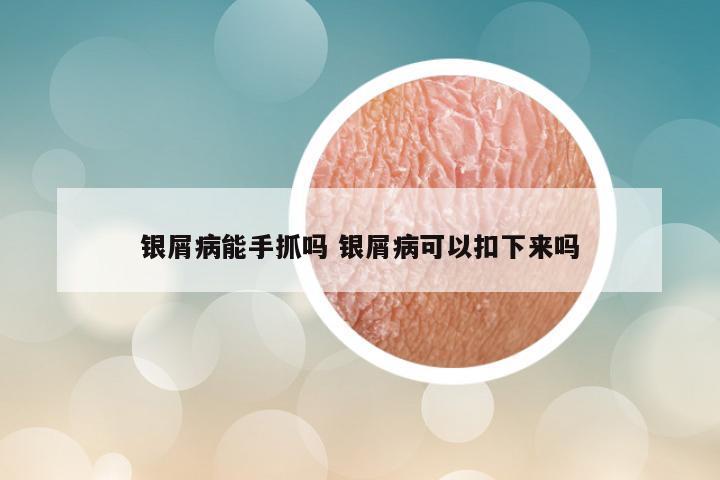 银屑病能手抓吗 银屑病可以扣下来吗