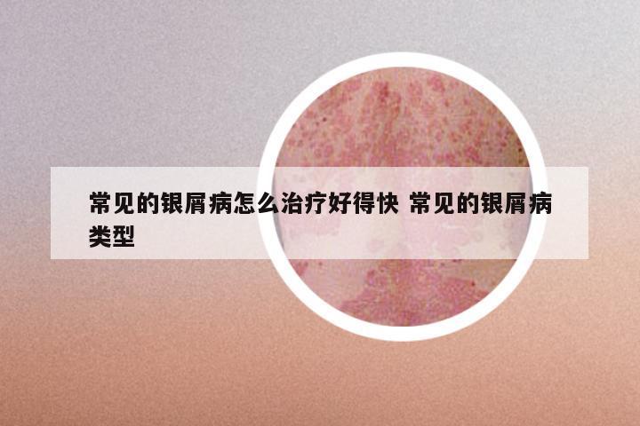 常见的银屑病怎么治疗好得快 常见的银屑病类型