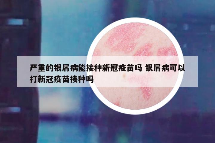 严重的银屑病能接种新冠疫苗吗 银屑病可以打新冠疫苗接种吗