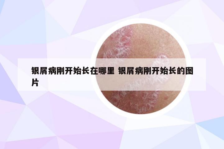 银屑病刚开始长在哪里 银屑病刚开始长的图片