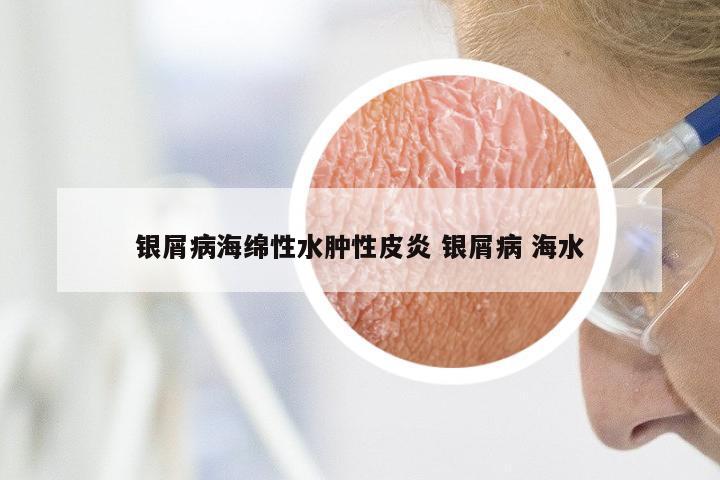 银屑病海绵性水肿性皮炎 银屑病 海水