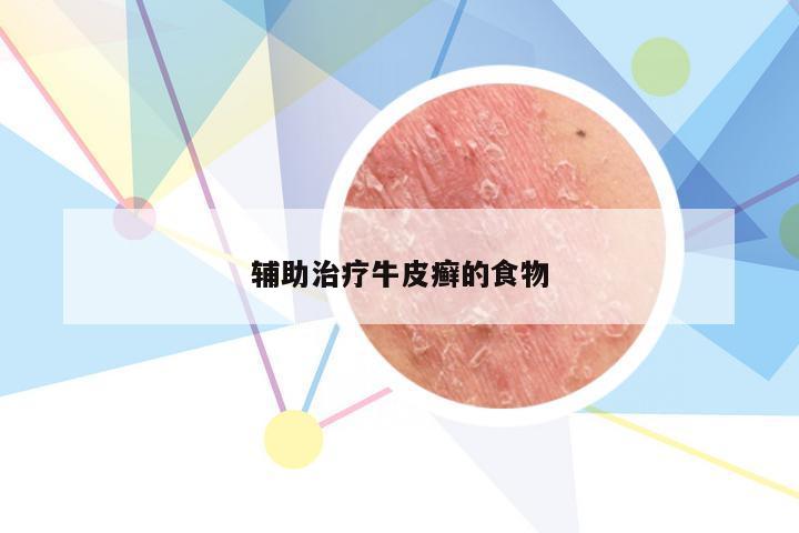 辅助治疗牛皮癣的食物