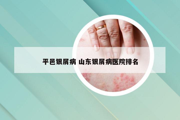 平邑银屑病 山东银屑病医院排名