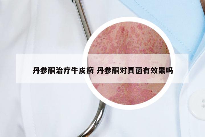 丹参酮治疗牛皮癣 丹参酮对真菌有效果吗