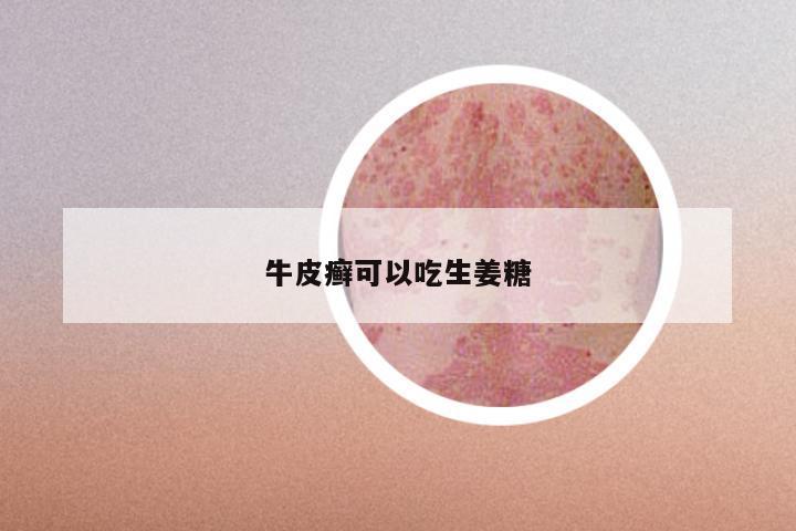 牛皮癣可以吃生姜糖