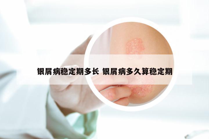 银屑病稳定期多长 银屑病多久算稳定期