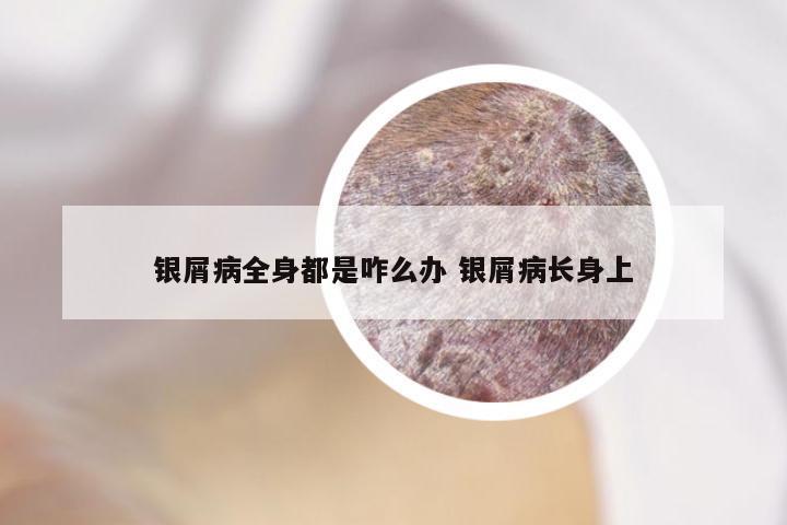 银屑病全身都是咋么办 银屑病长身上