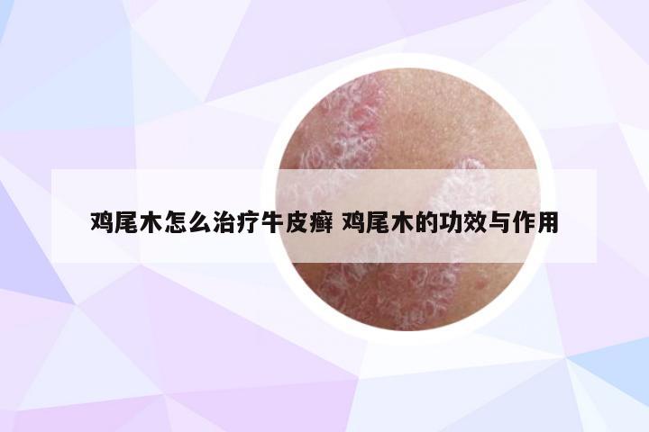 鸡尾木怎么治疗牛皮癣 鸡尾木的功效与作用
