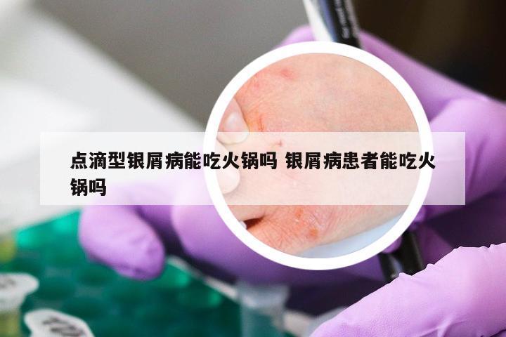 点滴型银屑病能吃火锅吗 银屑病患者能吃火锅吗