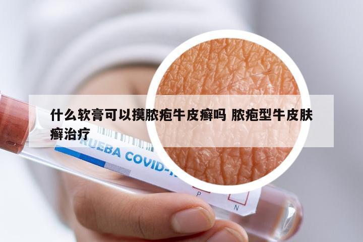 什么软膏可以摸脓疱牛皮癣吗 脓疱型牛皮肤癣治疗