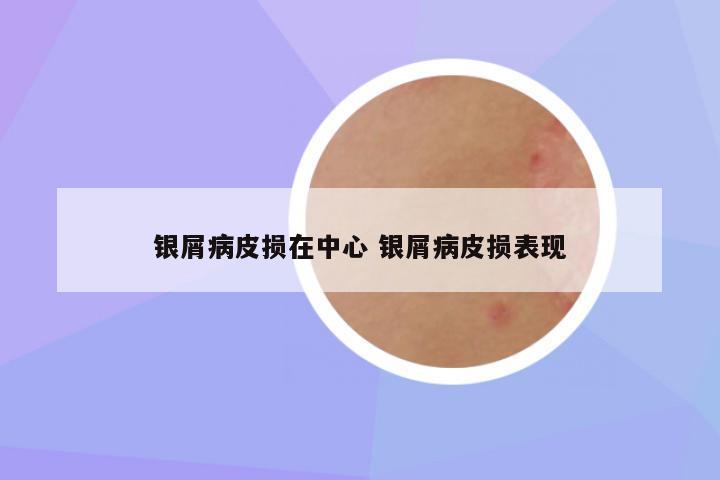 银屑病皮损在中心 银屑病皮损表现
