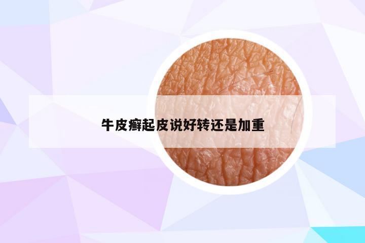 牛皮癣起皮说好转还是加重